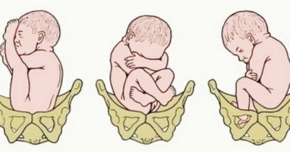 Nașterea cu prezentare pelviană - biomecanismul travaliului cu prezentare pelviană