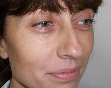 Septoplastia septului nazal, rectificarea operatiei de indreptare a nasului (curbura), preturile in