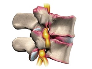 Cheyno-toracic simptome de osteochondrosis, tratament, semne