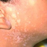 Simptomele și cauzele lichenului multicolor, prevenirea și tratamentul