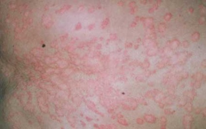 Simptomele și cauzele lichenului multicolor, prevenirea și tratamentul