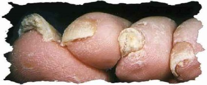 Amenințarea ascunsă este să înveți adevărul teribil despre ciupercă, până când îți taie unghiile!