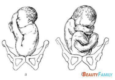 Prezentarea longitudinală pelviană a fotografiei fetusului, prezentarea fetală