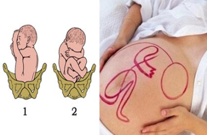 Prezentarea longitudinală pelviană a fotografiei fetusului, prezentarea fetală
