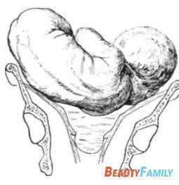 Prezentarea longitudinală pelviană a fotografiei fetusului, prezentarea fetală