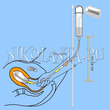 Tamponadă cu balon controlat pentru oprirea sângerării intrauterine