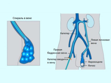 Varicocele 1 grad cauze, simptome și tratament