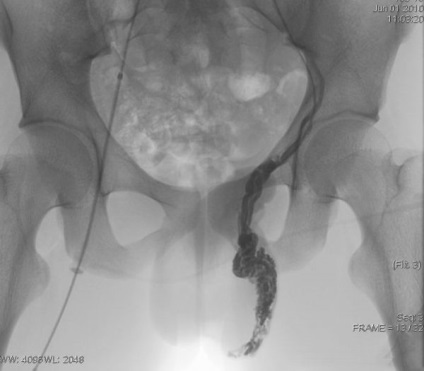 Varicocele 1 grad cauze, simptome și tratament