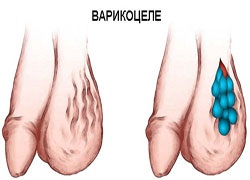 Varicocele cauzează