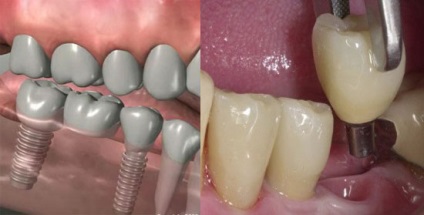 Tipuri de implantare a dinților