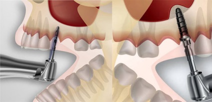 Tipuri de implantare a dinților