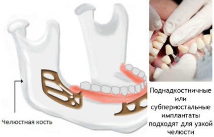 Tipuri de implantare a dinților