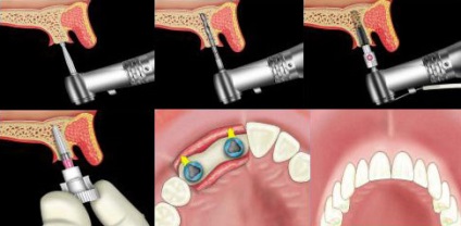 Tipuri de implantare a dinților