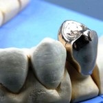 Tipuri de proteze dentare și o varietate de proteze