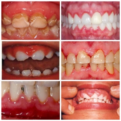 Inflamația gingiilor la copii, tratament, simptome, fotografie