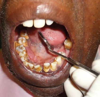 Simptomul cartilaginos al gingiei este o formă nosologică rară - chirurgie - știri și articole despre stomatologie
