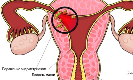 матката Аденомиоза какво е