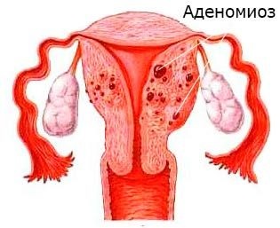 матката Аденомиоза какво е