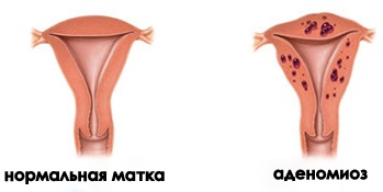 Ce este adenomioza uterului?