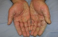 Allergiás dermatitis viszketéssel