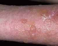 Allergiás dermatitis viszketéssel