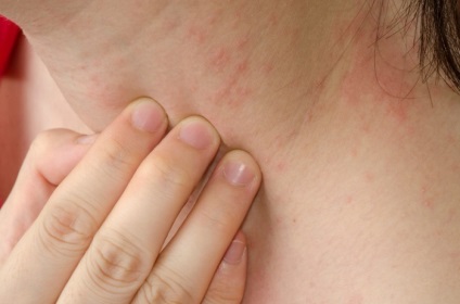 Allergiás dermatitis viszketéssel