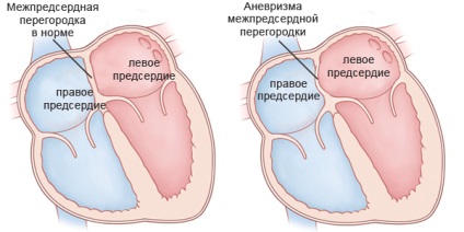 Anevrismul cauzat de septul interatrial, simptomele, diagnosticul și tratamentul