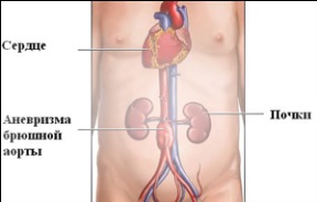 Anevrismele aortei abdominale