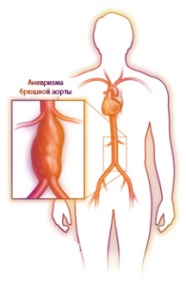 Anevrismele aortei abdominale