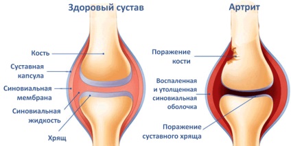 Arthrogryposis felnőttek és gyermekek okozza és a kezelés