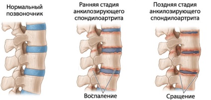 Artrogrioză la copii și adulți cauze și tratament