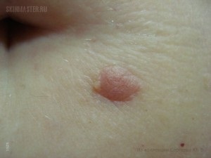 Simptome de melanom non-pigmentare, examinare