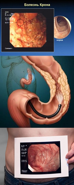 Boala lui Crohn