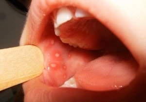 Възпалено език и парене в гърлото, както и появата на пъпки, причини и лечение