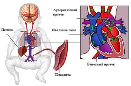 Ce înseamnă atunci când un copil are o fereastră ovală deschisă în inimă