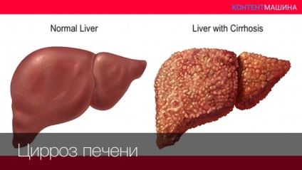 Ciroza hepatică cât de mulți trăiesc și cum să tratăm această boală