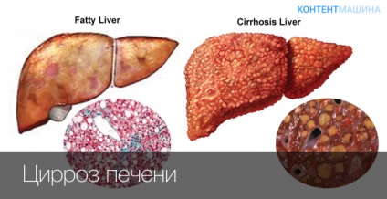 Ciroza hepatică cât de mulți trăiesc și cum să tratăm această boală