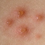 Photo dermatitis tünetei otthoni kezelés, népi jogorvoslati