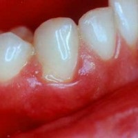 Gumele din spatele tratamentului dinților acasă, tratamentul stomatologic