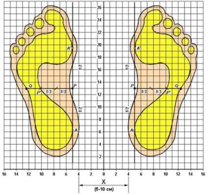 Flatfoot Diagnosis