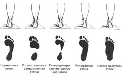 Flatfoot Diagnosis