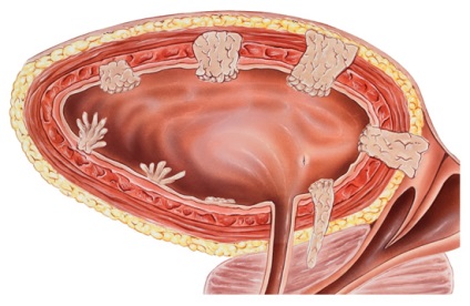 Neoplasme benigne ale organelor urinare ale rinichilor, pelvisului renal, ureterului, urinar