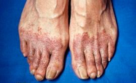 Eczemă la nivelul picioarelor și prevenirea