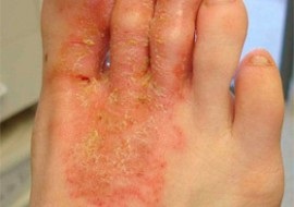Eczemă la nivelul picioarelor și prevenirea