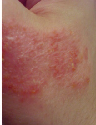 Eczemă la copii, simptome și tratament