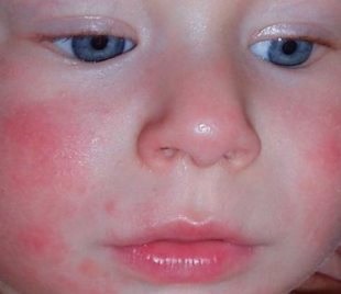 Ha gyermeke allergiás az arcon