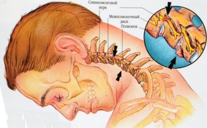 Acest lucru este important să știți! Principalele simptome ale osteocondrozei cervicale