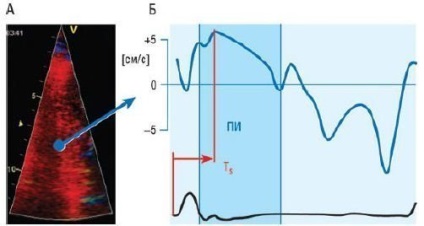 Echocardiografia insuficienței cardiace