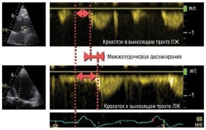 Echocardiografia insuficienței cardiace