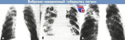 Tuberculoza pulmonară-cavernoasă a plămânului - clinică, diagnostic